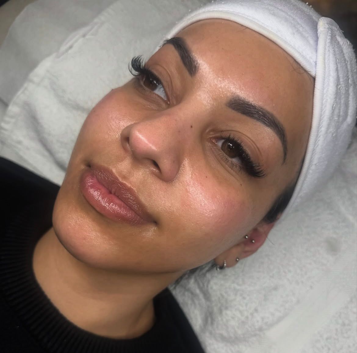 Aquafacial &amp; Microneedling