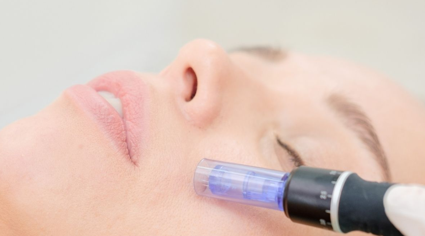 60 Min. Microneedling
