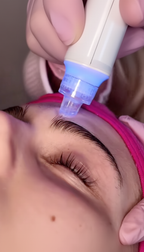 Aquafacial &amp; Microneedling