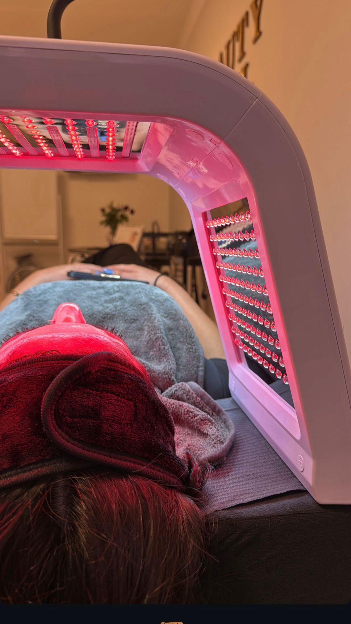 Microneedling
