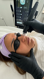 Diodenlaser Haarentfernung im Nasenbereich bei Samar Cosmetic Bochum – präzise Laserbehandlung mit Schutzbrille im Kosmetikstudio