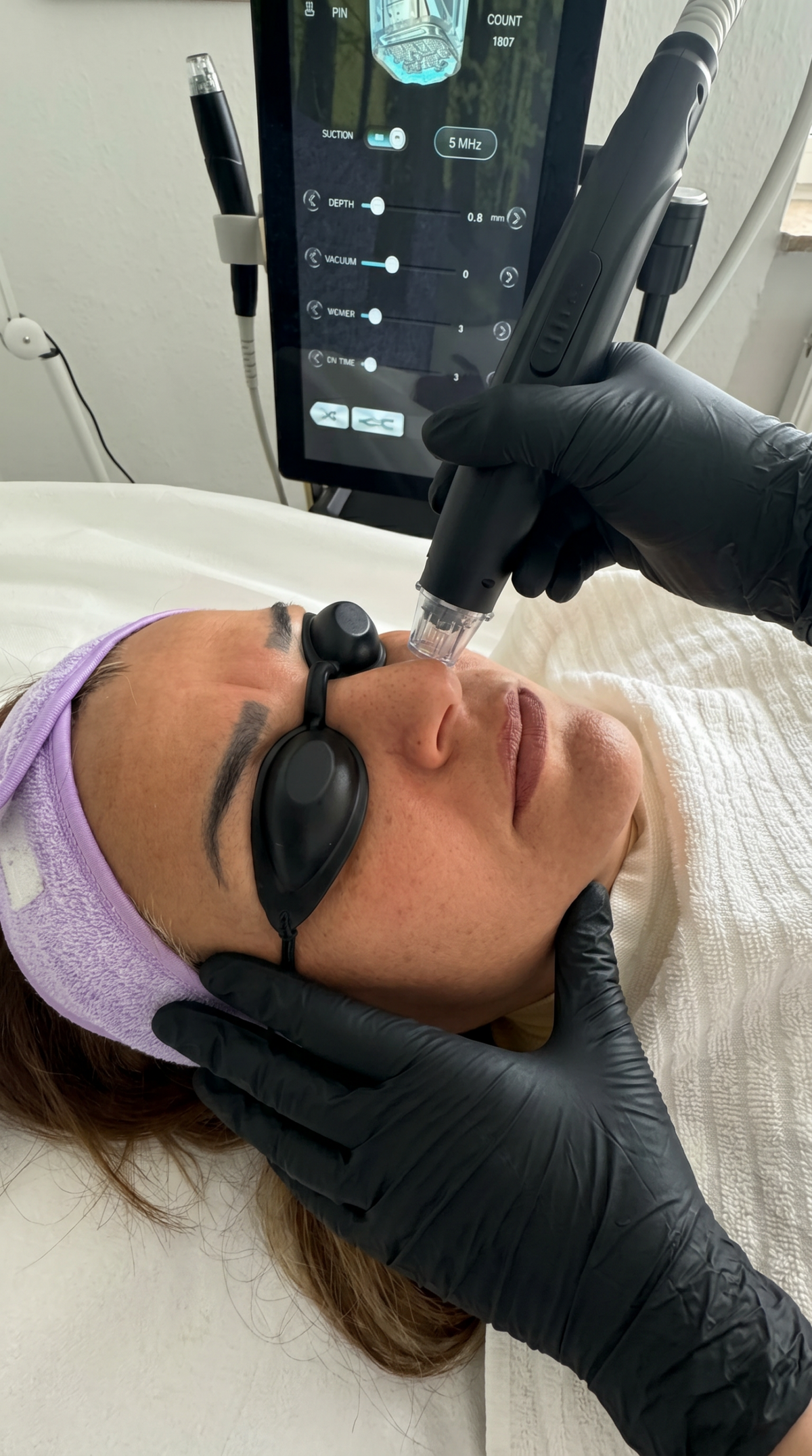Diodenlaser Haarentfernung im Nasenbereich bei Samar Cosmetic Bochum – präzise Laserbehandlung mit Schutzbrille im Kosmetikstudio