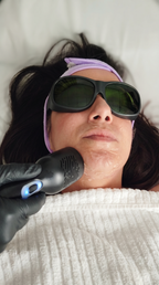 Diodenlaser Haarentfernung im Gesicht bei Samar Cosmetic Bochum – professionelle Laserbehandlung mit Schutzbrille zur dauerhaften Haarreduktion