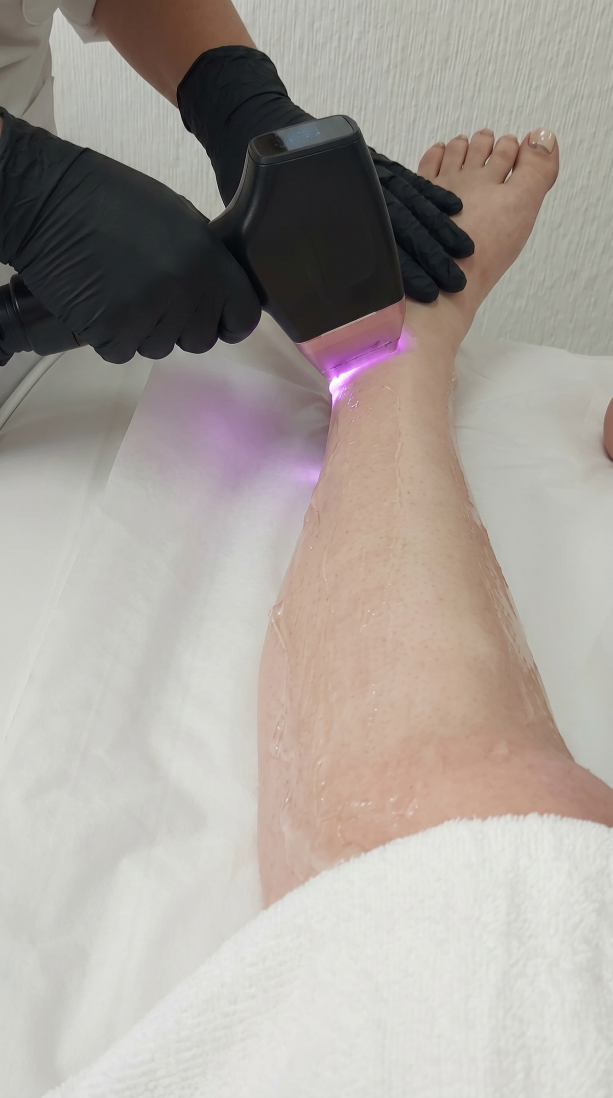 Diodenlaser Haarentfernung bei Samar Cosmetic Bochum – professionelle Laserbehandlung zur dauerhaften Haarreduktion an den Beinen