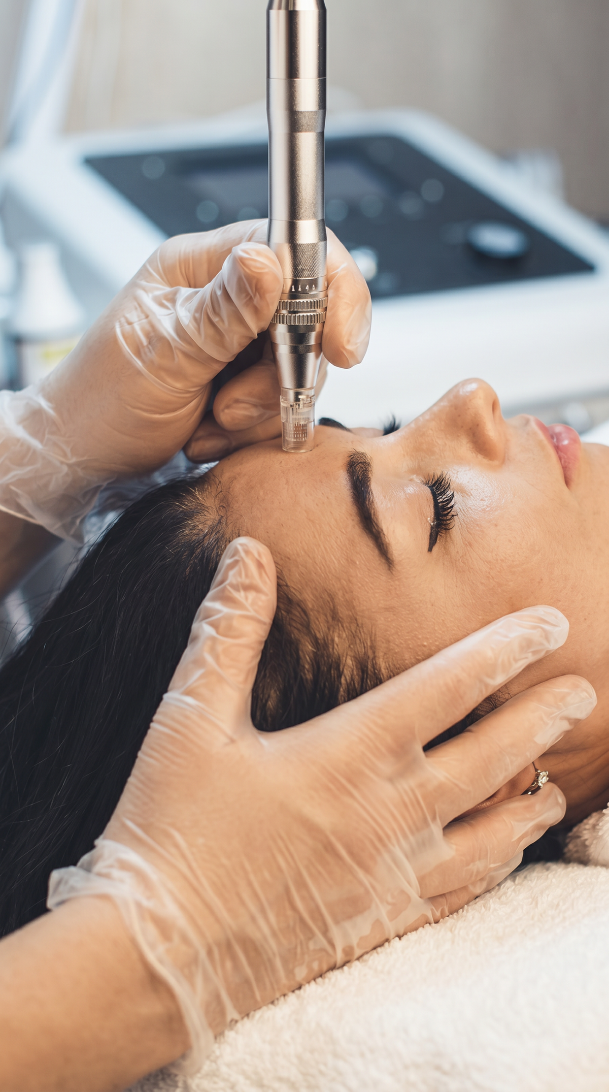 Microneedling bei Beve Beauty Hanau – professionelle Behandlung im Stirnbereich zur Anregung der Hauterneuerung und Verfeinerung des Hautbildes