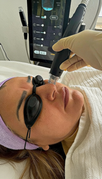 Radiofrequenz Microneedling bei Samar Cosmetic Bochum – professionelle Gesichtsbehandlung zur Hautstraffung, Kollagenanregung und Verfeinerung des Hautbildes