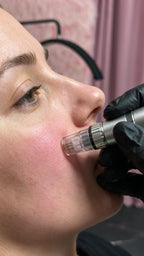 Kosmetisches Microneedling