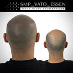 Vorher-Nachher-Bild einer Haarpigmentierung am Hinterkopf bei SMP Vato Essen